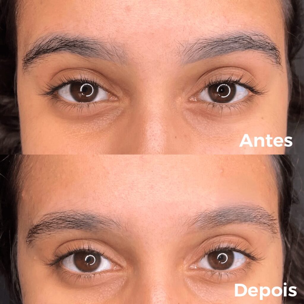 remocao-micropigmentacao-laser-sobrancelhas-comparativo-horizontal-2-tiny