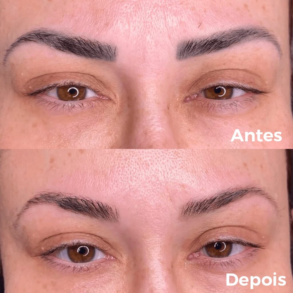 remocao-micropigmentacao-laser-sobrancelhas-comparativo-horizontal-tinified